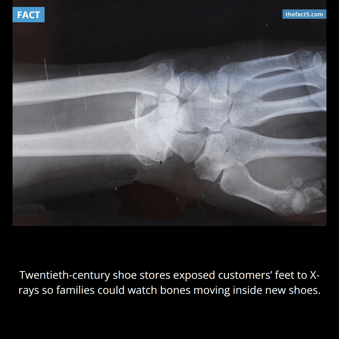 Shoe stores once X-rayed children just to sell sneakers. ☢️